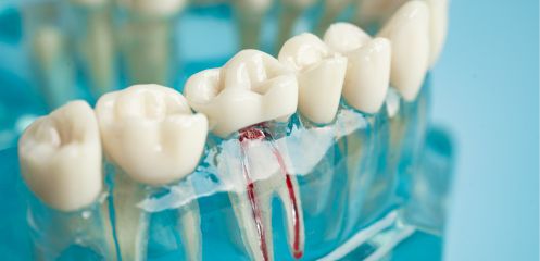After root canal treatment
